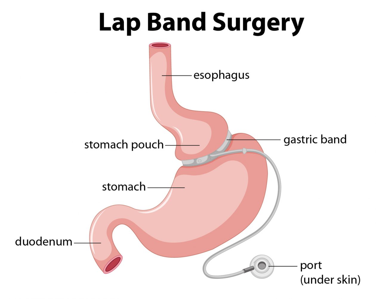 Be aware of Pros & Cons of Lap Band Surgery