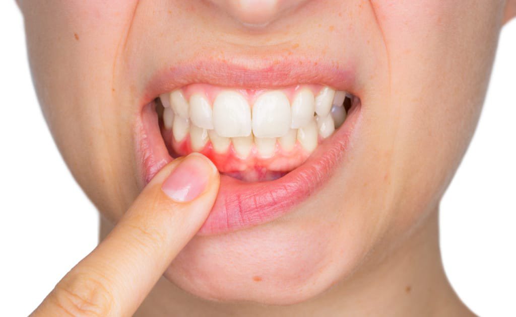 Periodontal Disease – Want to maintain your Teeth?